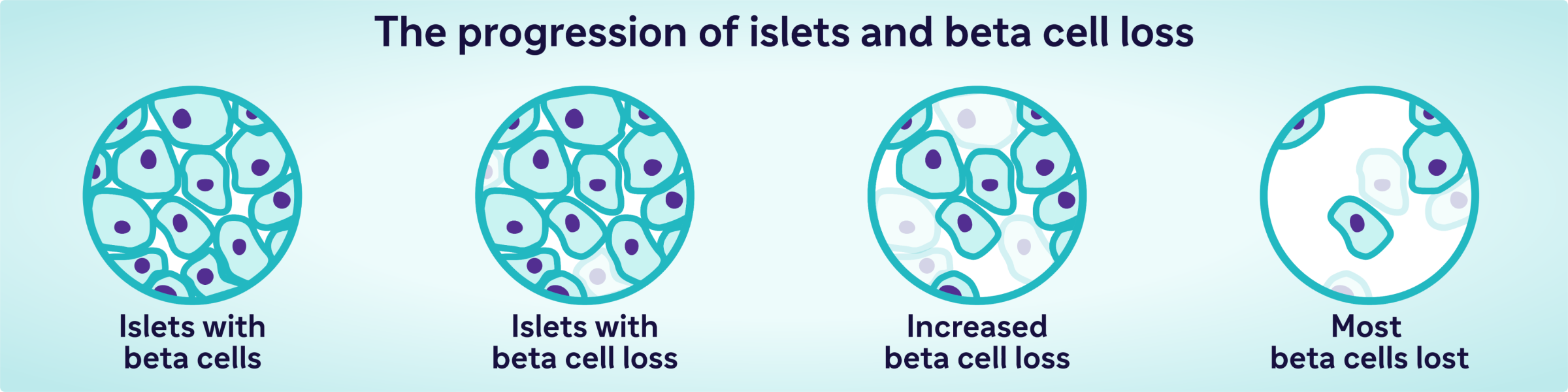 The progression of islets and beta cell loss: · Islets with beta cells · Islets with beta cell loss · Increased beta cell loss Most beta cells lost